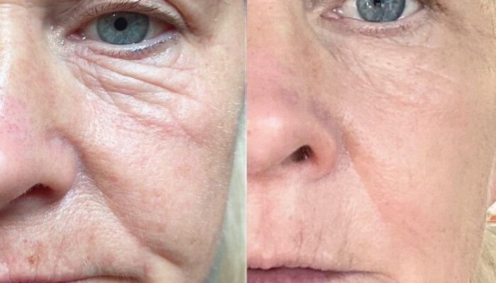 PLASMA FIBROBLAST BEFORE AND AFTER’S