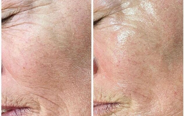 PLASMA FIBROBLAST BEFORE AND AFTER’S