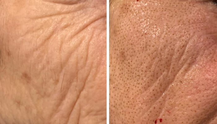 PLASMA FIBROBLAST BEFORE AND AFTER’S